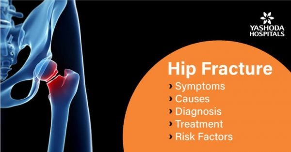 How to treat hip fractures?