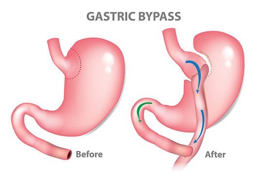 Bariatric surgery cost in Hyderabad