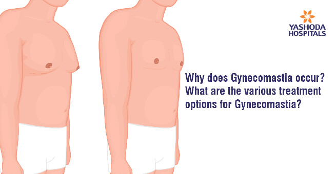 Why does Gynecomastia occur? What are the various treatment options for Gynecomastia?
