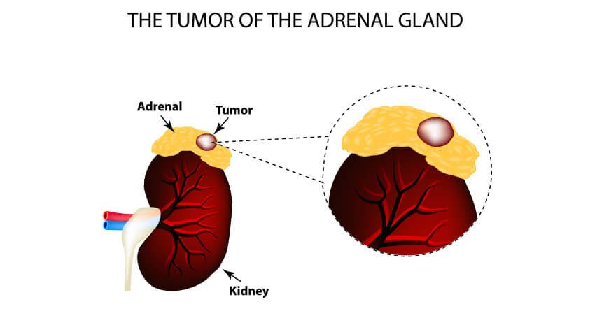 symptoms of an adrenal tumor