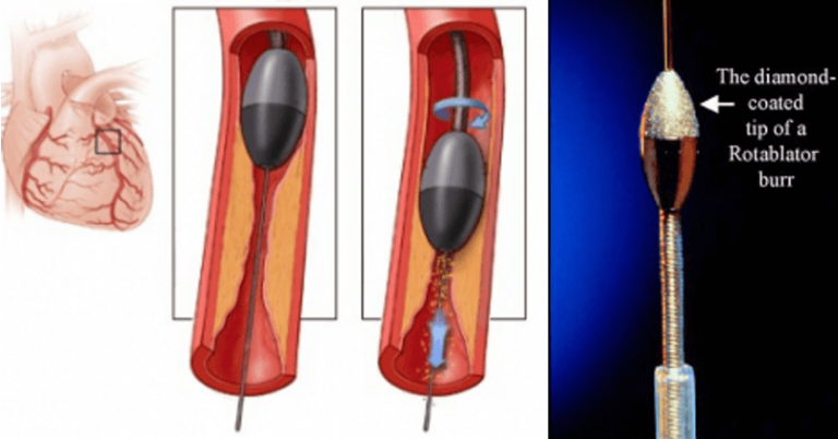 Coronary Angioplasty With Rotablation In Elderly