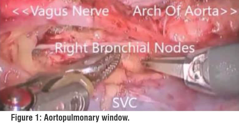aortopulmonary window robotic surgery