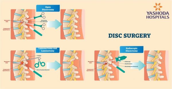 minimally-invasive-endoscopic-spine-surgery-best-treatment-for-spinal