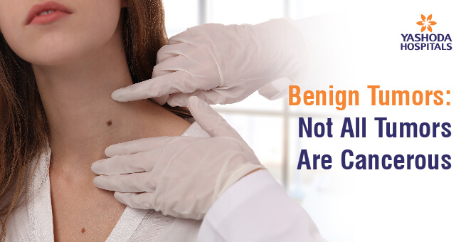 Benign Tumours-Not All Tumours Are Cancerous