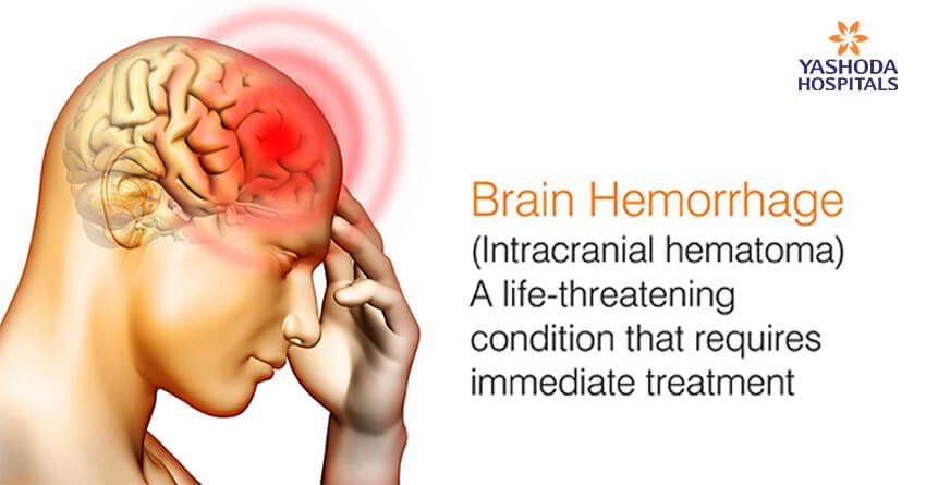 How to treat Brain Hemorrhage immediately?