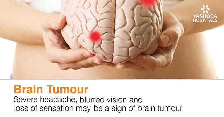 brain tumour severe headache
