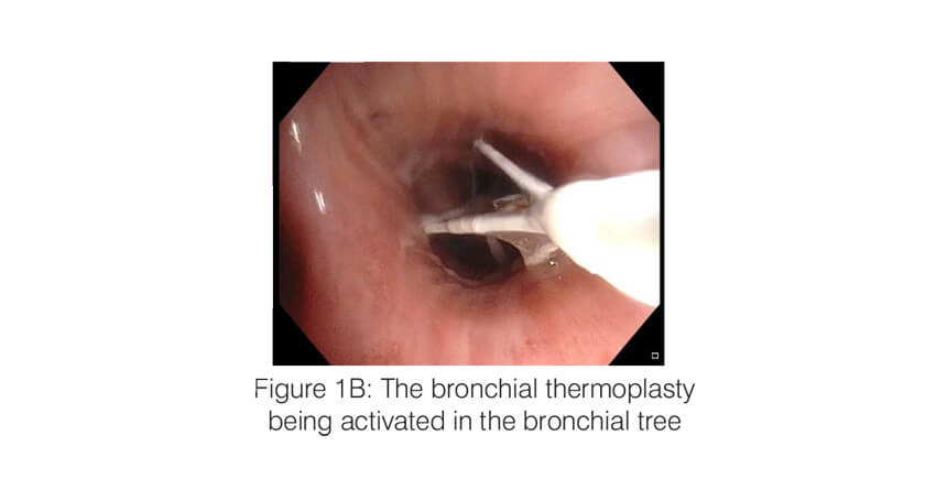 The bronchial thermoplastybeing activated in the bronchial tree