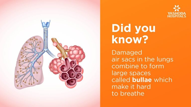 Lung Bullae Treated Using Bullectomy