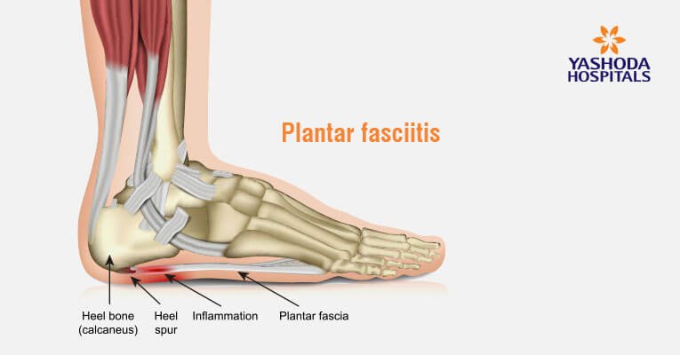 anterior heel pain