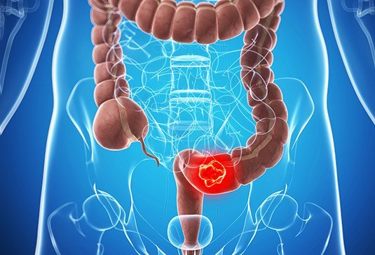 colon cancer cost in hyderabad, india