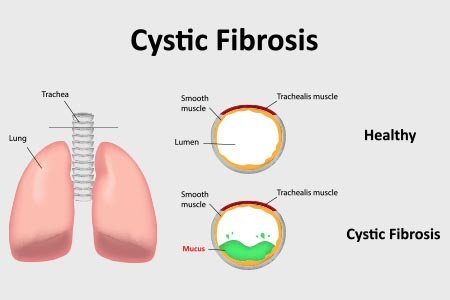 Fibrosis cystic Great Strides