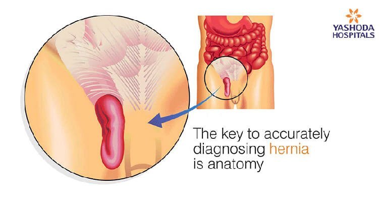 The key to accurately diagnosing hernia is anatomy