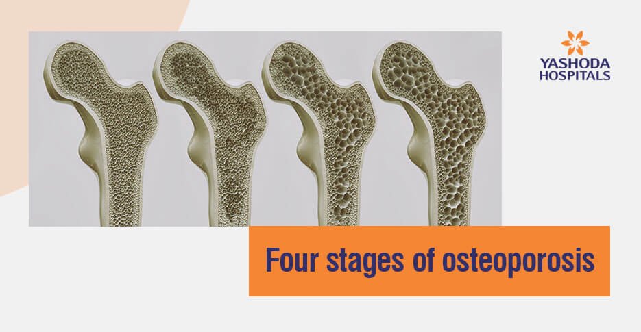 What Are The Symptoms And Stages Of Osteoporosis?