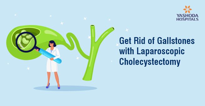 Get Rid of Gallstones with Laparoscopic Cholecystectomy