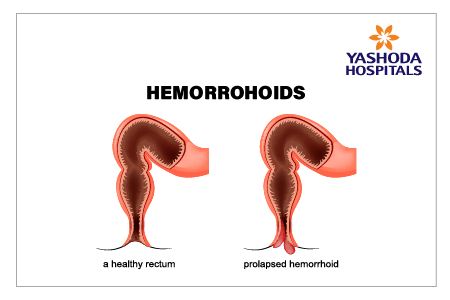 Anal treatment procedure