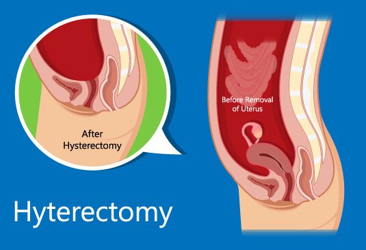 Hysterectomy Cost in Hyderabad