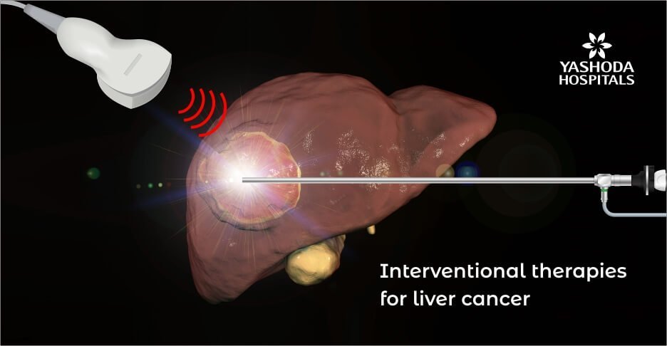 Minimally invasive interventional radiology therapies for liver cancer