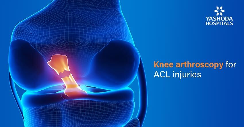 knee arthroscopy-Anterior Cruciate Ligament (ACL) injury