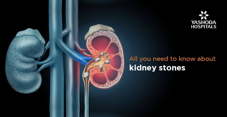 know about kidney stones