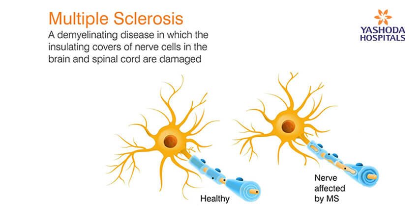 Multiple Sclerosis Symptoms And Treatment Sclerosis Of The Spine Spine And Brain