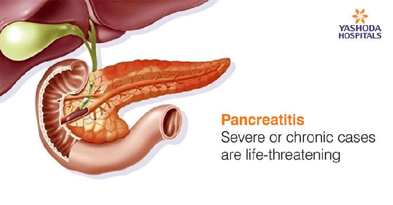 Pancreatitis: Severe or chronic cases are life-threatening
