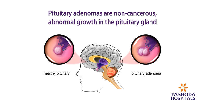 Pituitary Gland Tumors Important Things To Know About 0255