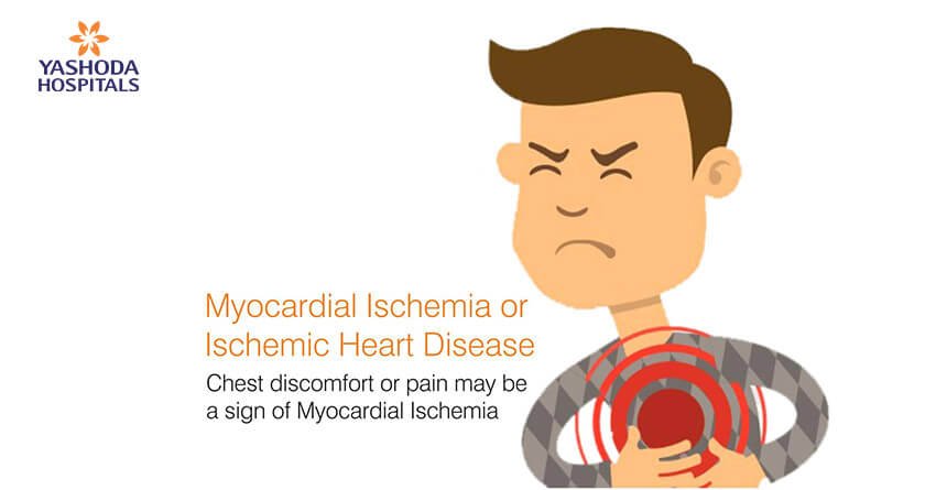 sign of myocardial ischemia
