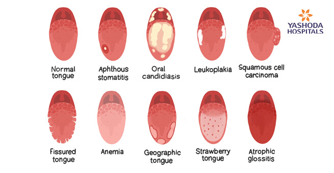Tongue Cancer Stages Symptoms Causes Diagnosis And Treatment
