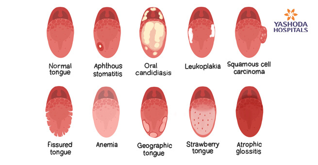 Tongue Cancer Stages Causes Symptoms Preventions The Best Porn Website