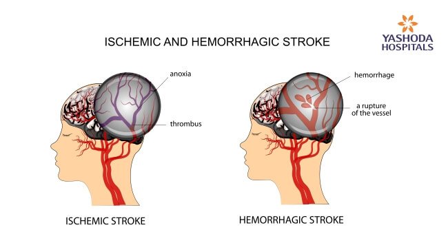 Brain Stroke: Symptoms, Types, Risk Factors, Diagnosis and Treatment