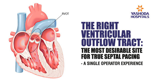 the right ventricular tract