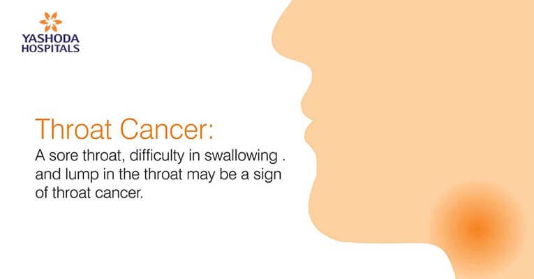 throat Cancer difficulty in swallowing