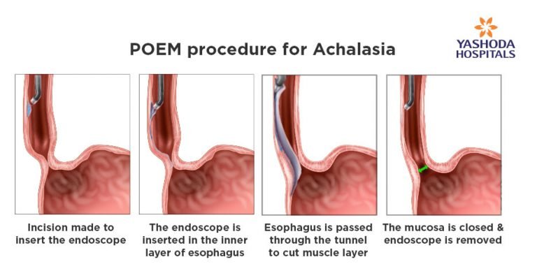 Peroral Endoscopic Myotomy Poem For Achalasia