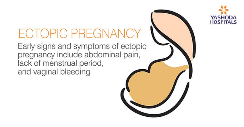 tubal pregnancy or ectopic pregnancy
