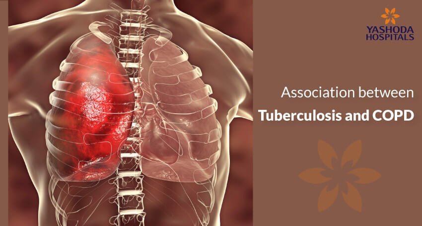 Does tuberculosis cause COPD, pulmonary fibrosis or restrictive lung disease?