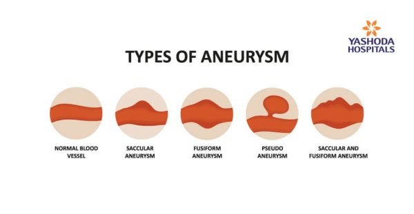 Aneurysms Its Causes Symptoms Diagnosis And Treatment 4580