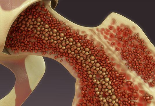 bone marrow transplant procedure