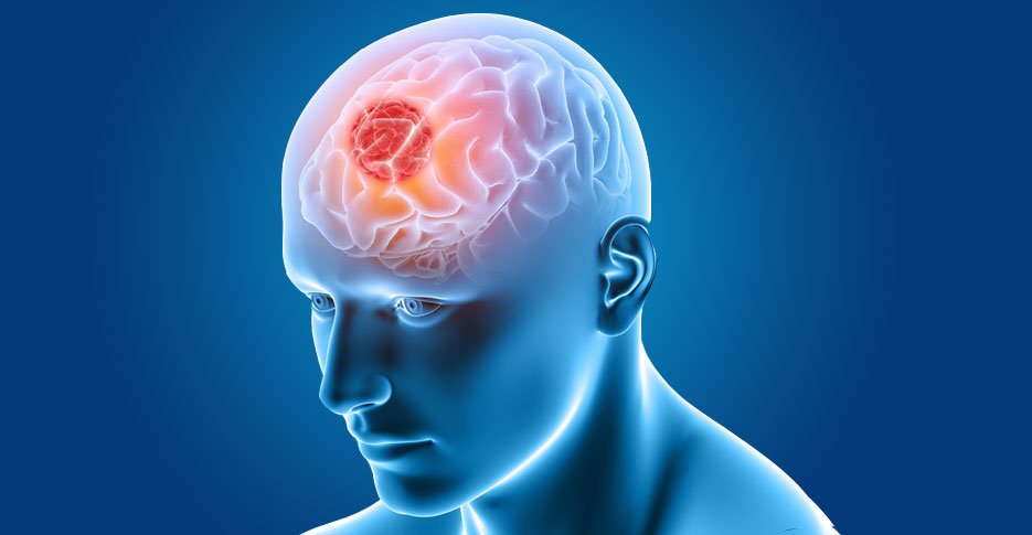 understanding-brain-tumours