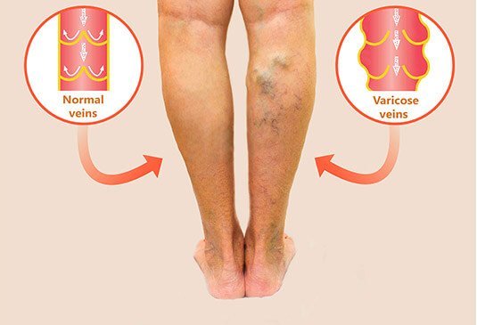 venele foarte vizibile pe picioarele varicoasei cum se vindeca vene varicoase nu picioarele