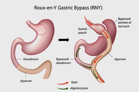 Roux-en-y Gastric Bypass (RYGB)