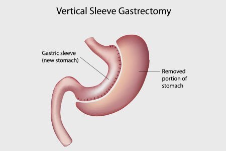Laparoscopic Gastric Sleeve Resection (LGSR)
