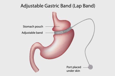 Laparoscopic Adjustable Gastric Banding (LAGB)